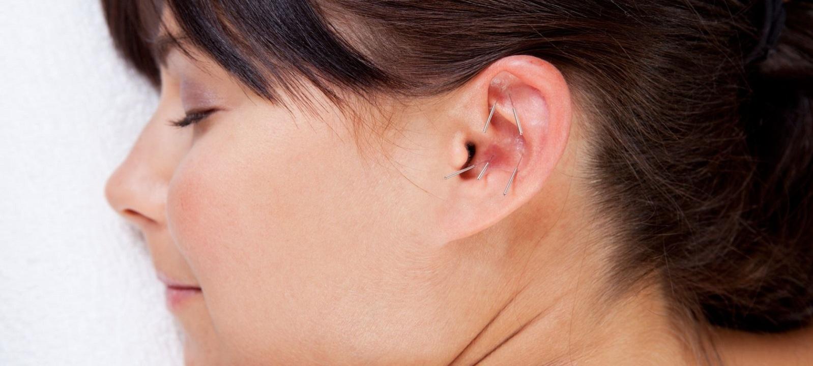 耳針, 耳穴, 王不留行籽