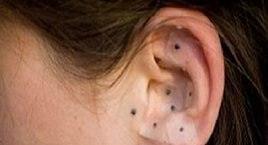 耳穴, 耳針, 王不留行籽