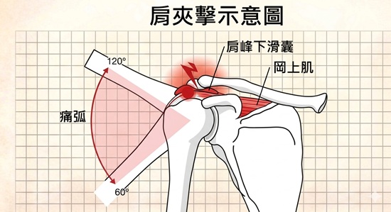 肩夾擊綜合症